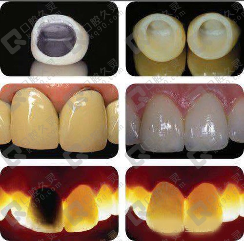 比金屬基底烤瓷修復體美觀,半透明與天然牙近似,修復後更佳自然
